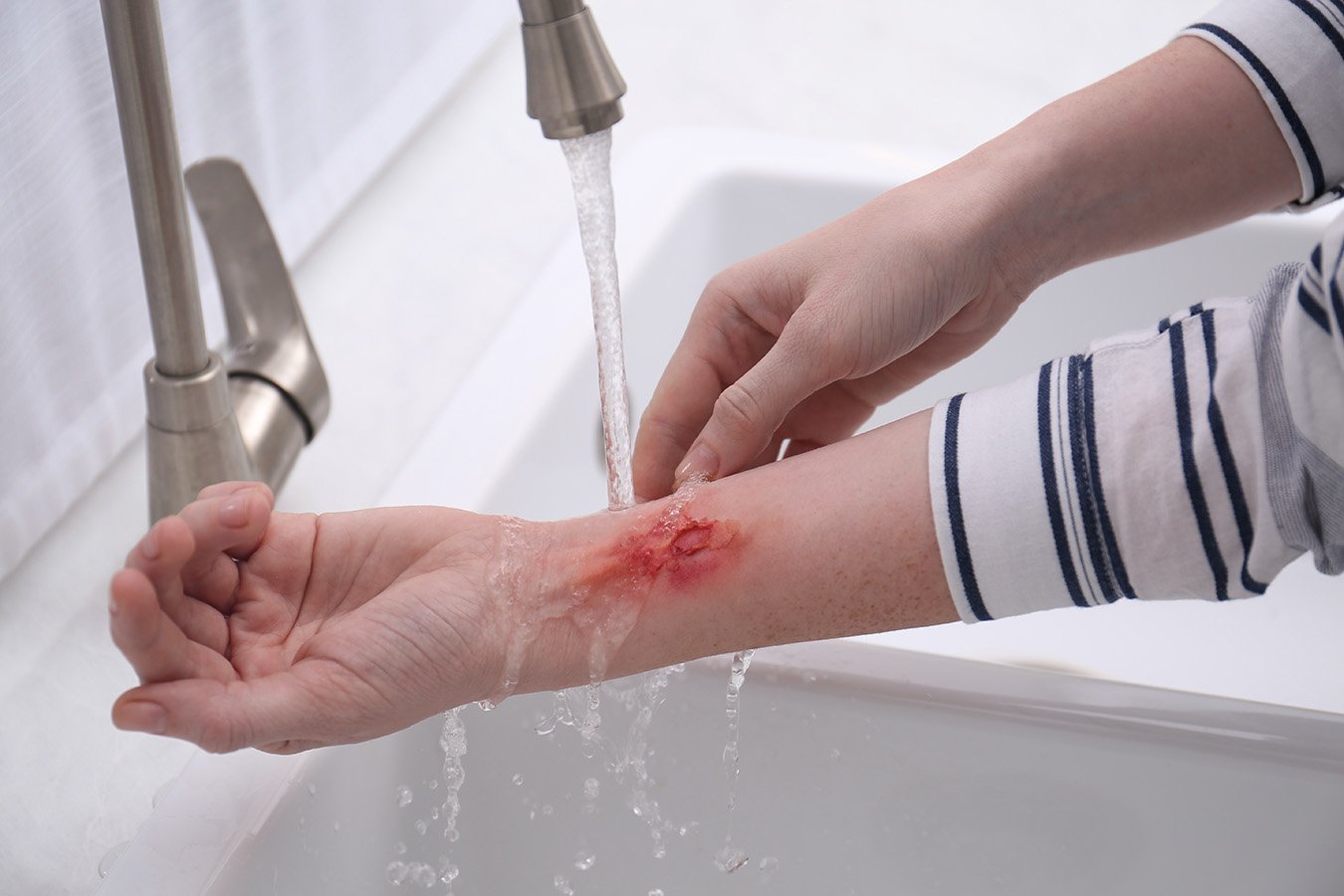 Burn Care Treatment